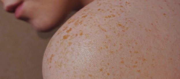 Image of bare freckly shoulder